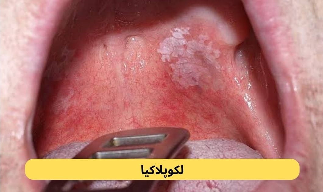 لکوپلاکیا نوعی تغییر در بافت داخل دهان است که معمولاً به شکل لکه یا پلاک سفید دیده می‌شود. این ضایعات دهان و لثه به‌راحتی از بین نمی‌روند.