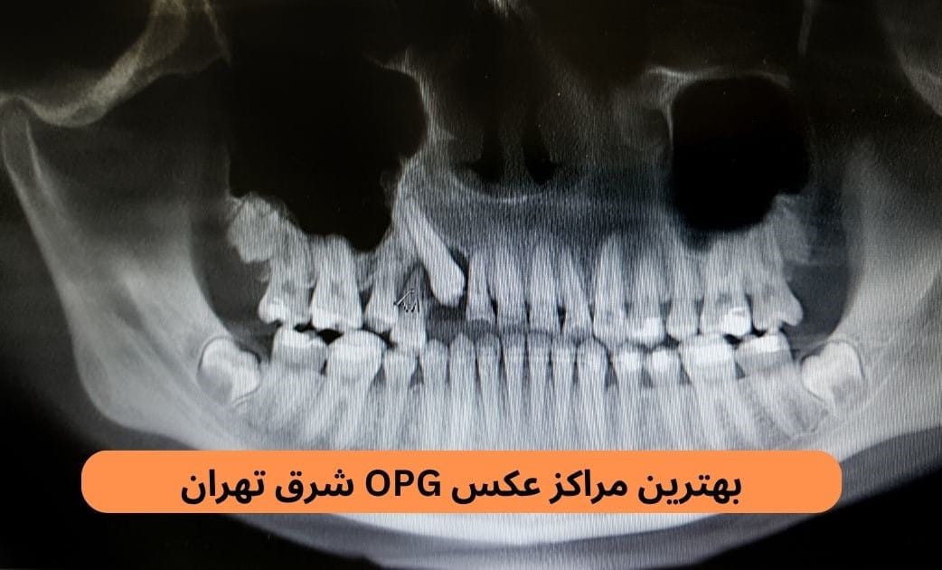 بهترین مراکز عکس OPG شرق تهران براساس پارامترهایی چون رعایت بهداشت، سرعت جواب‌دهی، داشتن مجوز، رضایت مردم، نوبت‌دهی آنلاین و موارد دیگر.
