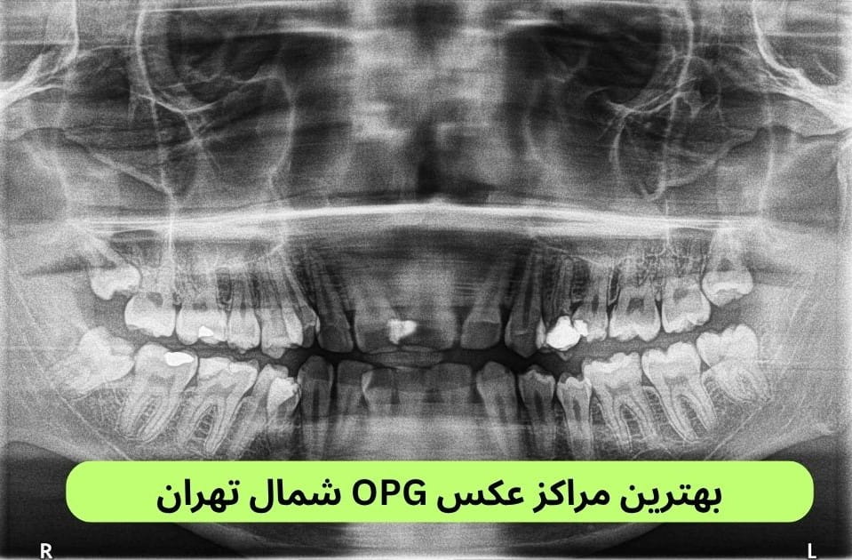 برای یافتن بهترین مرکز عکس OPG شمال تهران توجه به مواردی چون کیفیت خدمات، دسترسی، سرعت جواب‌دهی، رضایت مراجعین و غیره ضروری است.