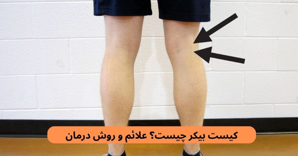 کیست بیکر یک برجستگی پر از مایع در پشت زانو است. مفصل زانو حاوی مایع سینوویال است که حرکت سطوح مفصلی را آسان می‌کند.