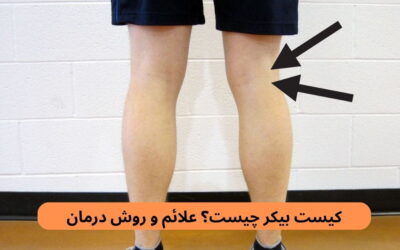 کیست بیکر چیست؟ علائم و روش درمان