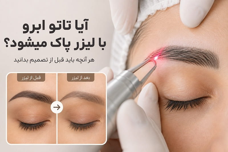 آیا تاتو ابرو با لیزر پاک میشود؟ آیا تاتو ابرو با لیزر پاک میشود؟