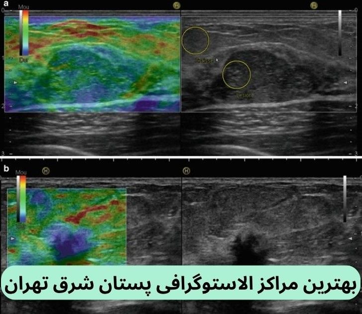 لیست بهترین مراکز الاستوگرافی پستان شرق تهران به همراه آدرس براساس نظرات مردم، کیفیت خدمات، دسترسی و موارد دیگر.