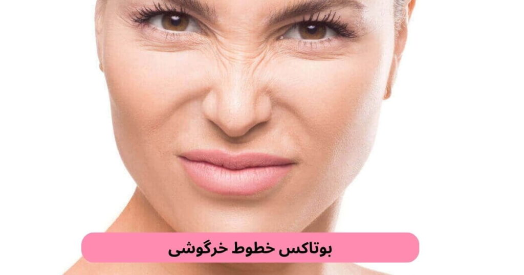 تزریق بوتاکس خطوط خرگوشی بینی روشی است که با کمک سم بوتولینوم سیگنالهای عصبی را که به انقباض عضلات منجر میشوند مسدود میکند.