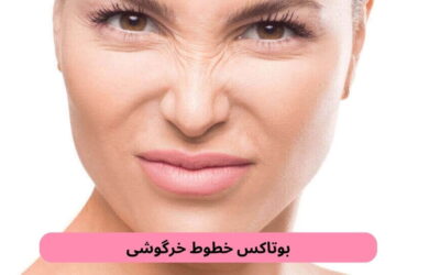 بوتاکس خطوط خرگوشی: بهترین راه حذف خطوط روی بینی