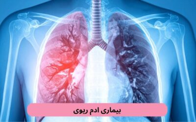 بیماری ادم ریوی