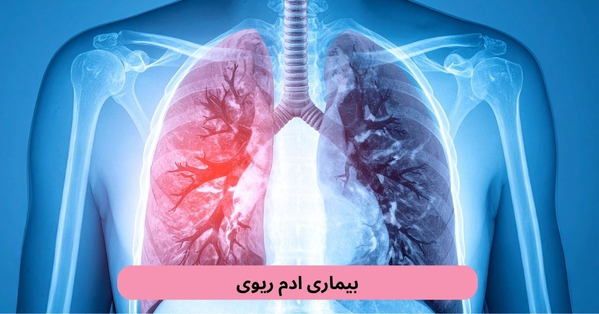 بیماری ادم ریوی یکی از اختلالاتی است که می‌تواند تنفس فرد را تحت تأثیر قرار دهد و در برخی موارد به‌صورت ناگهانی بروز کند.
