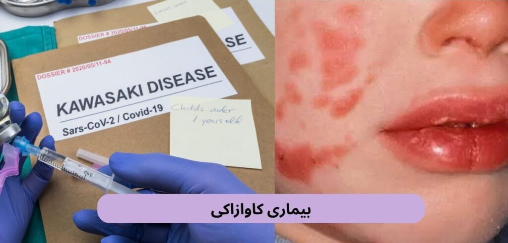 بیماری کاوازاکی یک بیماری التهابی نسبتاً نادر است که بیشتر در کودکان کمسن دیده میشود و میتواند رگهای خونی را درگیر کند.