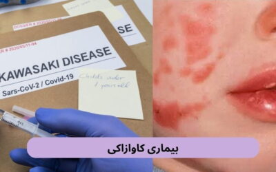 بیماری کاوازاکی